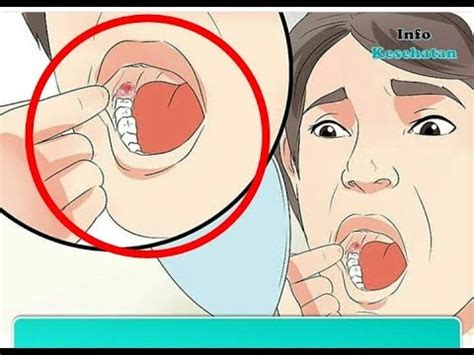 Penyebab dan cara mengatasi nyeri tulang belakang dan sakit leher setiap bangun tidur. Cara Menghilangkan Bengkak Di Gusi Belakang