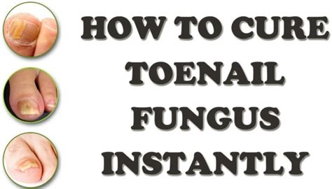 Home Remedy For Toenail Fungus