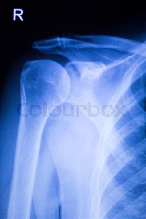 Shoulder Joint Orthopedic Xray Scan Stock Image Colourbox