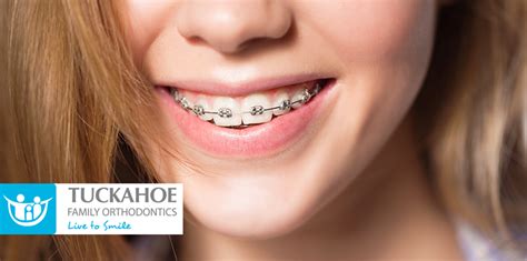 Did you know that many invisalign® patients have already worn traditional metal braces? How Long Does Orthodontic Treatment Typically Last?