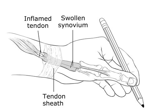 De Quervains Tenosynovitis Symptoms And Treatment Orthoinfo Aaos