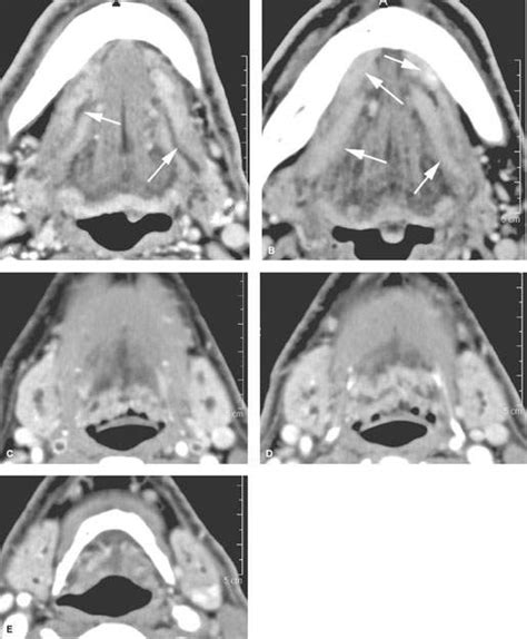 Submandibular Gland And Space Infectious And Noninfectious