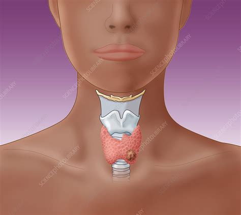 Thyroid Cancer Illustration Stock Image C0277595 Science Photo