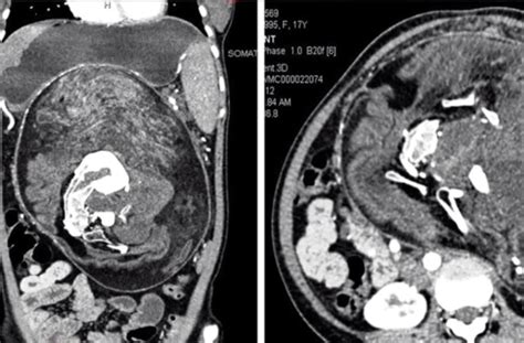 Doctors Find Twin Growing Inside 17 Year Old Girls Stomach