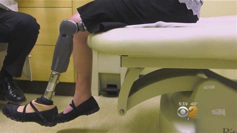 New Surgery Relieves Nerve Pain For Amputees Youtube
