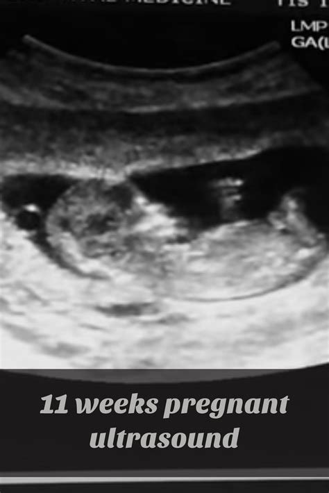 At 11 weeks pregnant, some of the rapid fetal developments underway include: 11 Weeks Pregnant (ALL YOU NEED TO KNOW | 11 weeks ...