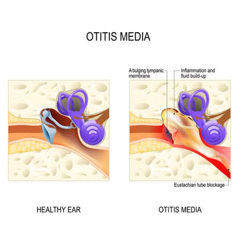 Otitis Media In Adults Causes And Symptoms
