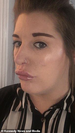 Mother Claims Botched Lip Filler Left Her With Duck Lips And Blood