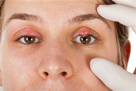 eyelid redness causes symptoms inflamed dry itchy swollen red eyelids treatments and