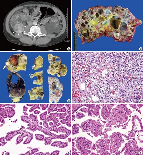 Multifocal Renal Cell Carcinoma Of Different Histological Subtypes In