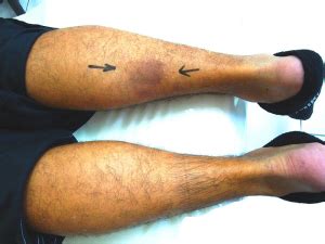 Peroneal tendon subluxation is when the peroneal tendons snap out of place. faudzil.blogspot.com: LEG PAIN - Calf Muscle Pain