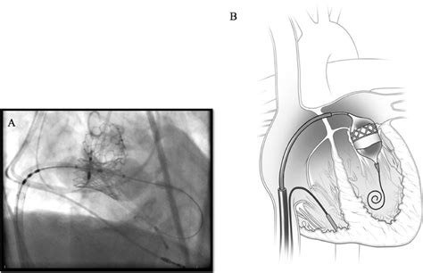 Transcatheter Double Valve Replacement Of An Aortic And Mitral Valve In