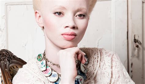 No Black Or White The Complexity Of Living With Albinism