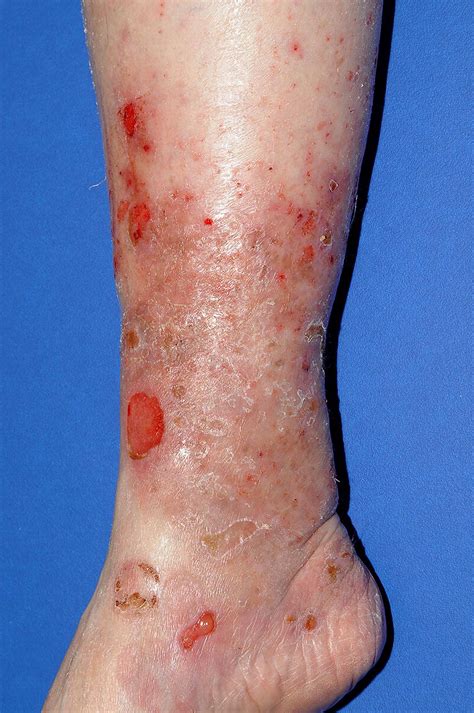 Clinical Features And Practical Diagnosis Of Bullous Pemphigoid