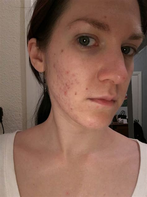 My Hormonal Acne Disappeared After Going Vegan The