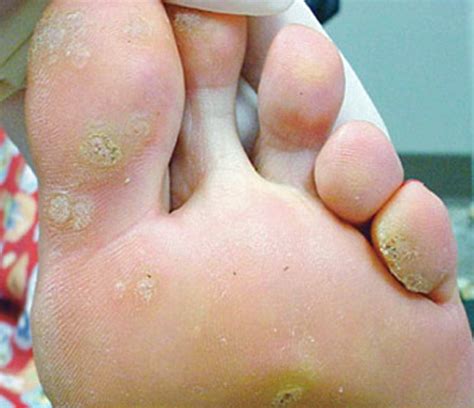 Warts On Feet Medical Point