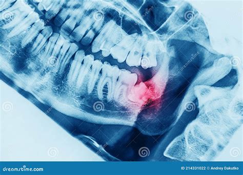 X Ray Oral Image With An Inflamed Wisdom Tooth Close Up Stock Photo