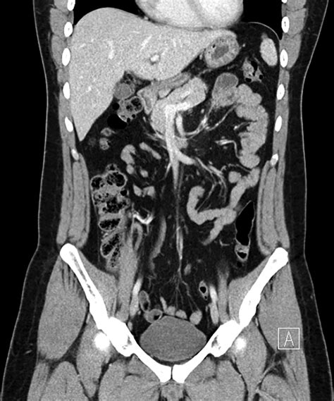 Normal Abdominal Ct Scan With Contrast