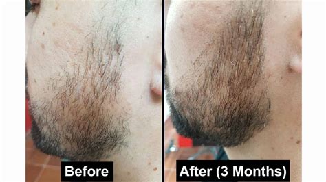 Rogaine Beard Treatments Can Minoxidil Grow A Better Beard