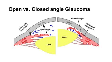 In the acute form, the iop rises rapidly as a result of relatively sudden. Closed Angle Glaucoma - Eyes Wide Bay