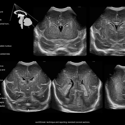 Normal Lateral Ventricle Male Twin Born At 26 Weeks Gestation And
