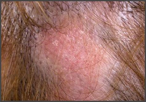 Pictures Of Shingles On The Scalp Shingles Expert
