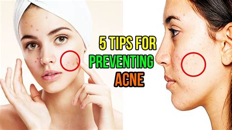 How Can I Prevent Pimples On My Face 5 Tips For Preventing Acne