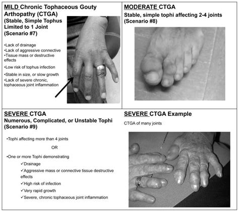 2012 American College Of Rheumatology Guidelines For Management Of Gout
