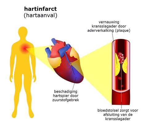 Hartinfarct Hartaanval Slingeland Ziekenhuis