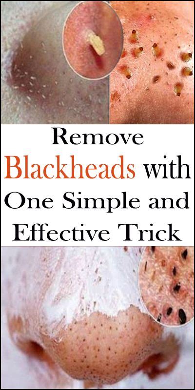 Remove Blackheads With One Simple And Effective Trick Remedies Well