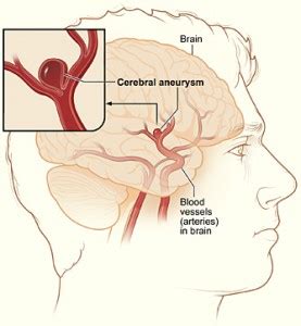Difference Between Avm And Brain Aneurysm Difference Between
