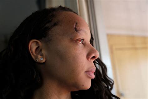 Official Apologizes To Woman Hit By Rubber Bullet In Protest Wpec