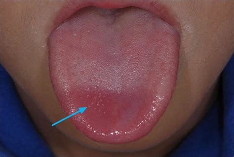 Large White Bump On Tongue