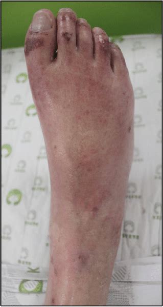 Blue To Purple Discoloration With Petechiae On The Right Foot