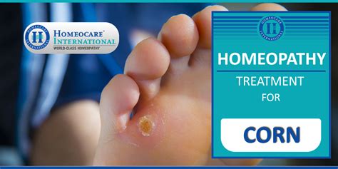 Homeopathy Treatment For Corns Homeocare International