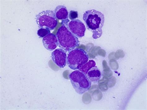 Mantle Cell Lymphoma Mcl And Lesismaniasis