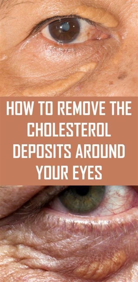 How To Remove The Cholesterol Deposits Around Your Eyes Cholesterol