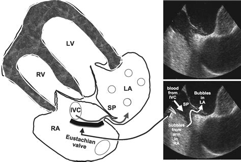 Contemporary Management Of Patent Foramen Ovale Circulation