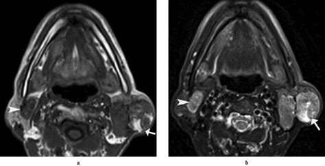 Bilateral Parotid Swelling A Radiological Review Abstract Europe Pmc