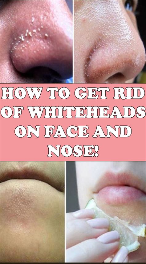How To Get Rid Of Whiteheads On Nose And Face Dry Skin On Face