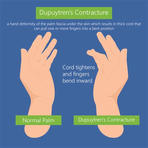 Dupuytrens Contracture Treatment In Sydney