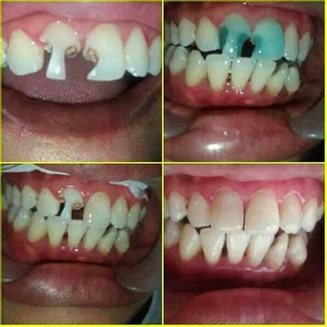 Tukang gigi indah 085733126436 - Home