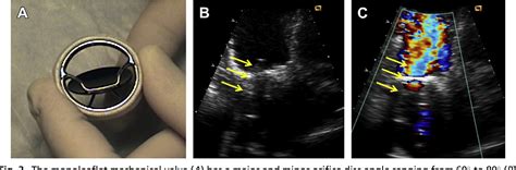 Figure 6 From Mitral Prosthetic Valve Assessment By Echocardiographic
