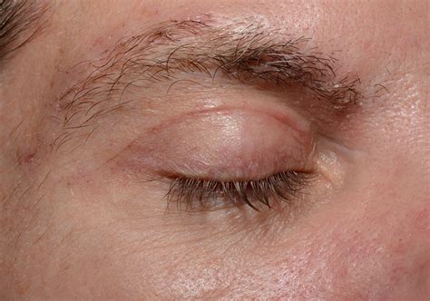 Tired Of Looking Tired Eyelid Surgery Charleston Facial Plastic