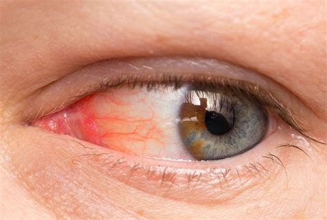 Remedios Caseros Para Las Infecciones En Los Ojos