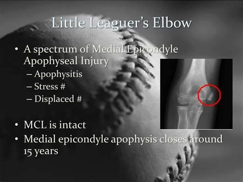 Ppt The Throwing Athletes Elbow Powerpoint Presentation Free