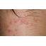 An Introduction To The Types Of Itchy Skin Rashes » TheHealthDiarycom