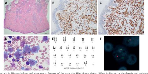 Pdf Acute Myeloid Leukemia In An Infant With T819p112q13