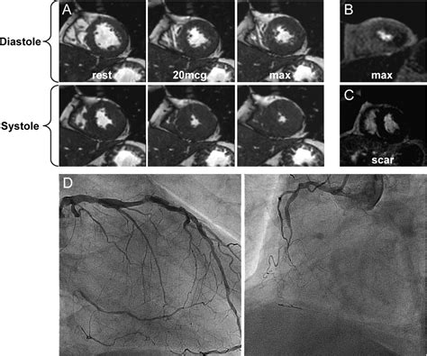 Influence Of Left Ventricular Hypertrophy And Geometry On Diagnostic