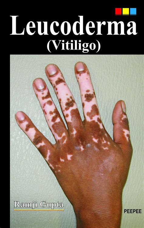 Leucoderma Vs Vitiligo Ubicaciondepersonascdmxgobmx